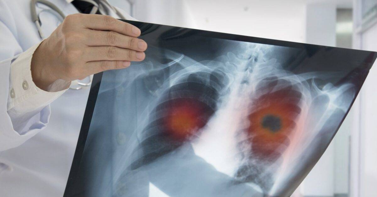 doctor reviewing chest x-rays for signs of rare mesothelioma