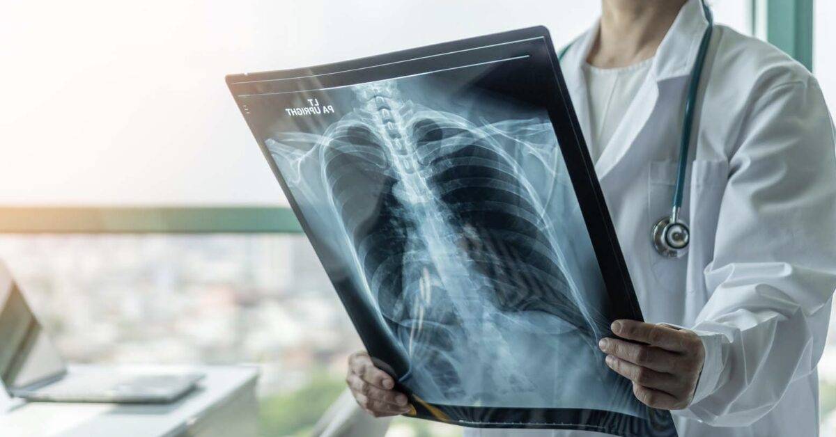 Doctor diagnosing patients pleural mesothelioma stage