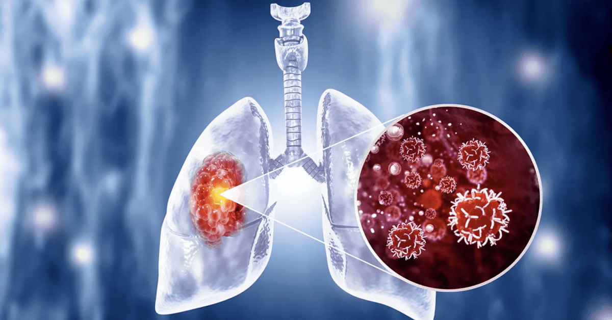 Talcum Powder and Lung Cancer