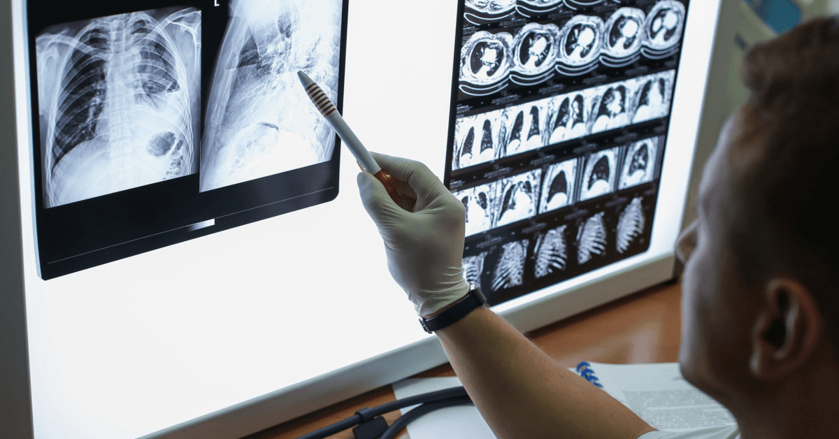 Pleural and Peritoneal Mesothelioma Found in Female Patient