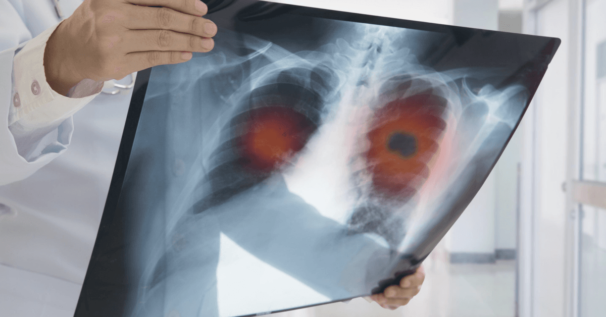 Finding the Right Mesothelioma Specialists in the US