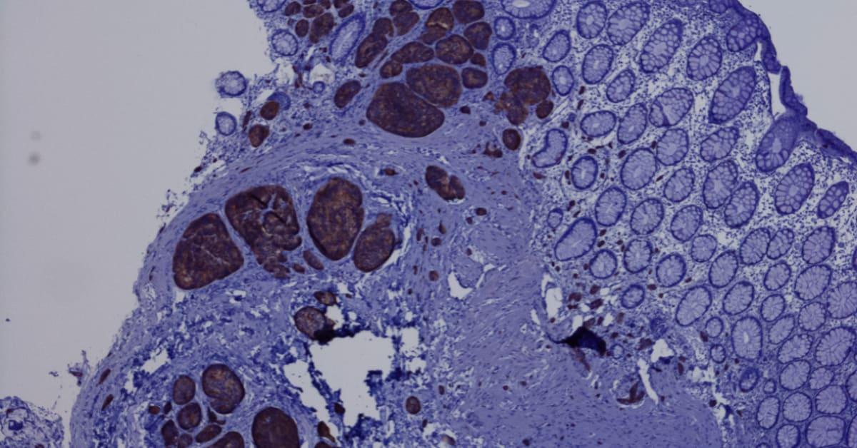 Study Finds Staining Tests Alone Can’t Reliably Diagnose Mesothelioma