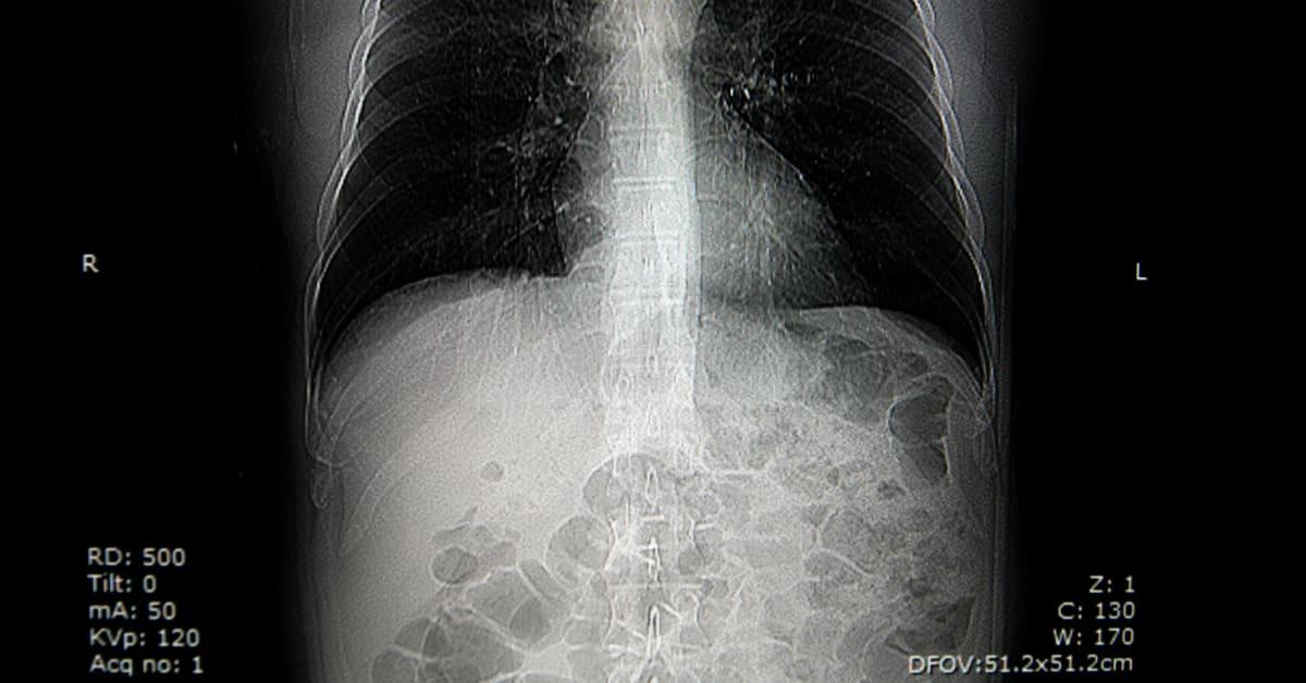 CT Scanning Not Reliable for Correct Diagnosis of Pleural Mesothelioma, says new study