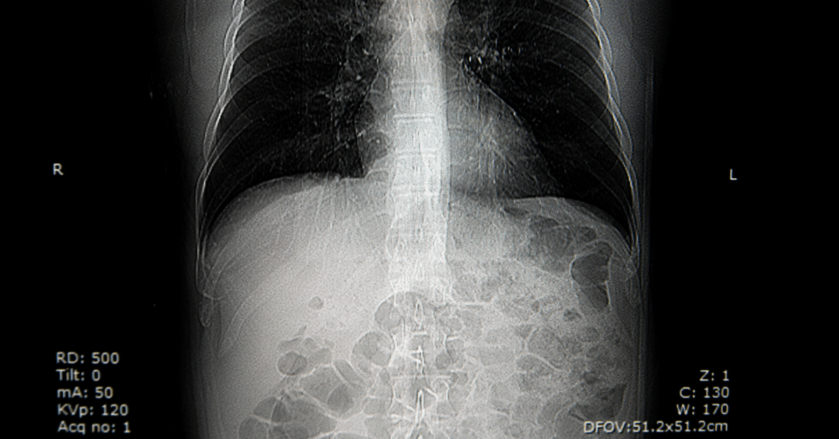 CT scan of lungs for pleural mesothelioma