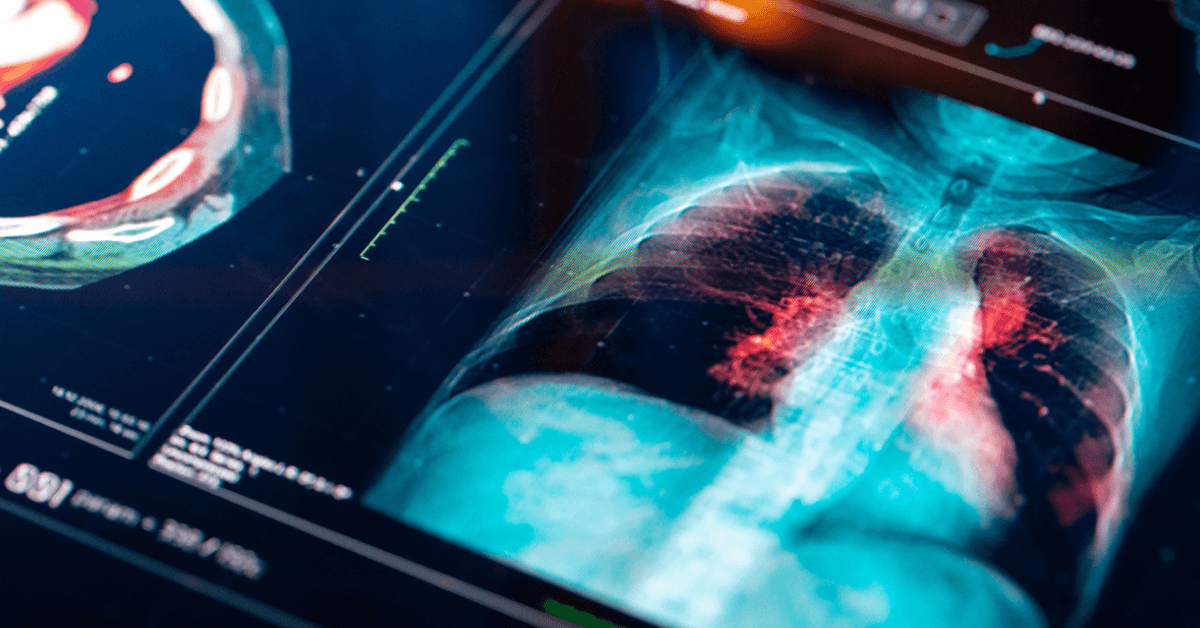 mesothelioma biomarkers