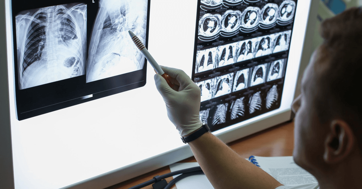 Pleural and Peritoneal Mesothelioma in a Female Patient