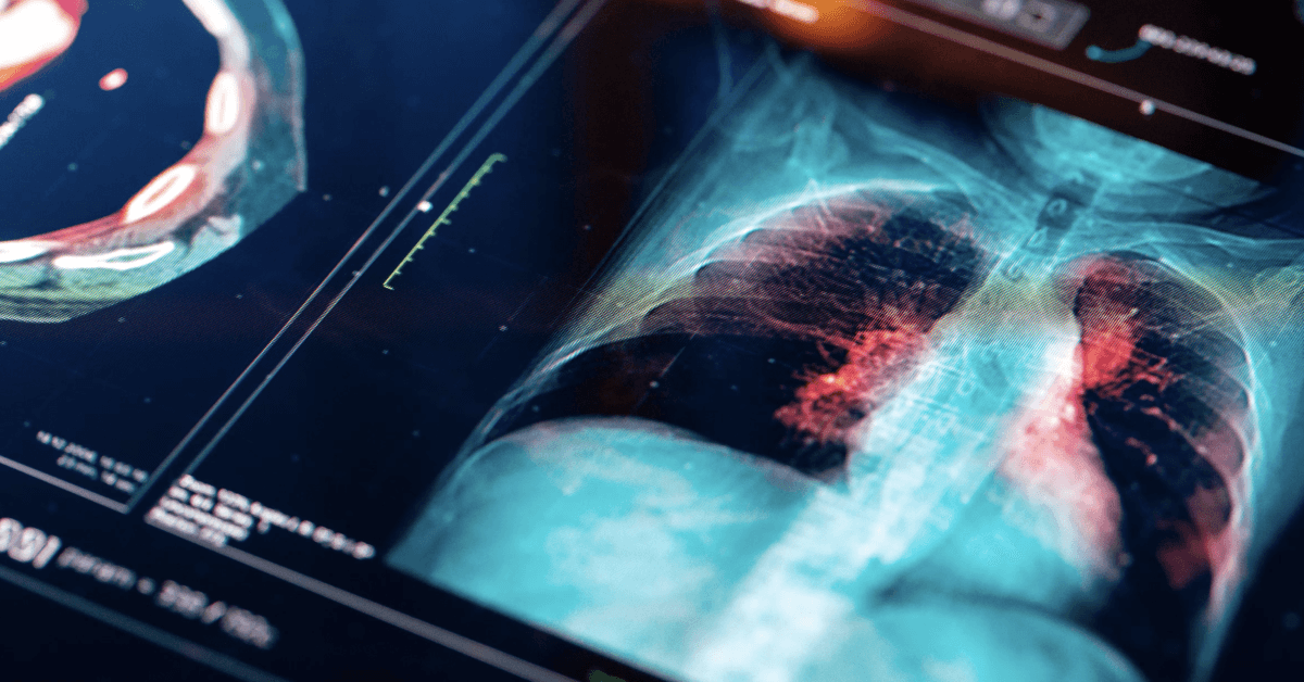 talc based lung cancer trends and incidence image of MRI